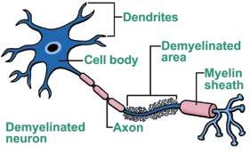 Illustration of a demyelinated neuron
